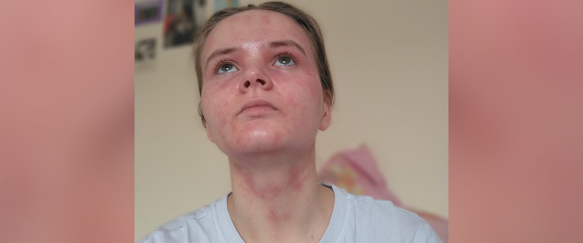 "Skin conditions are not simply a cosmetic issue, and in fact they can be associated with many psychological conditions." Person with eczema flare up