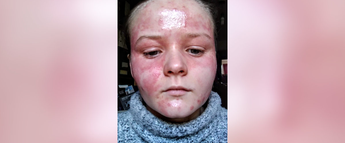 "Flares tend to go away after a few weeks, but I had severe rashes, weeping and redness all over my body for years." Person with eczema flare up
