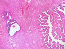 Rapid endometriosis test on the brink of ending miserable eight-year average wait for diagnosis for millions