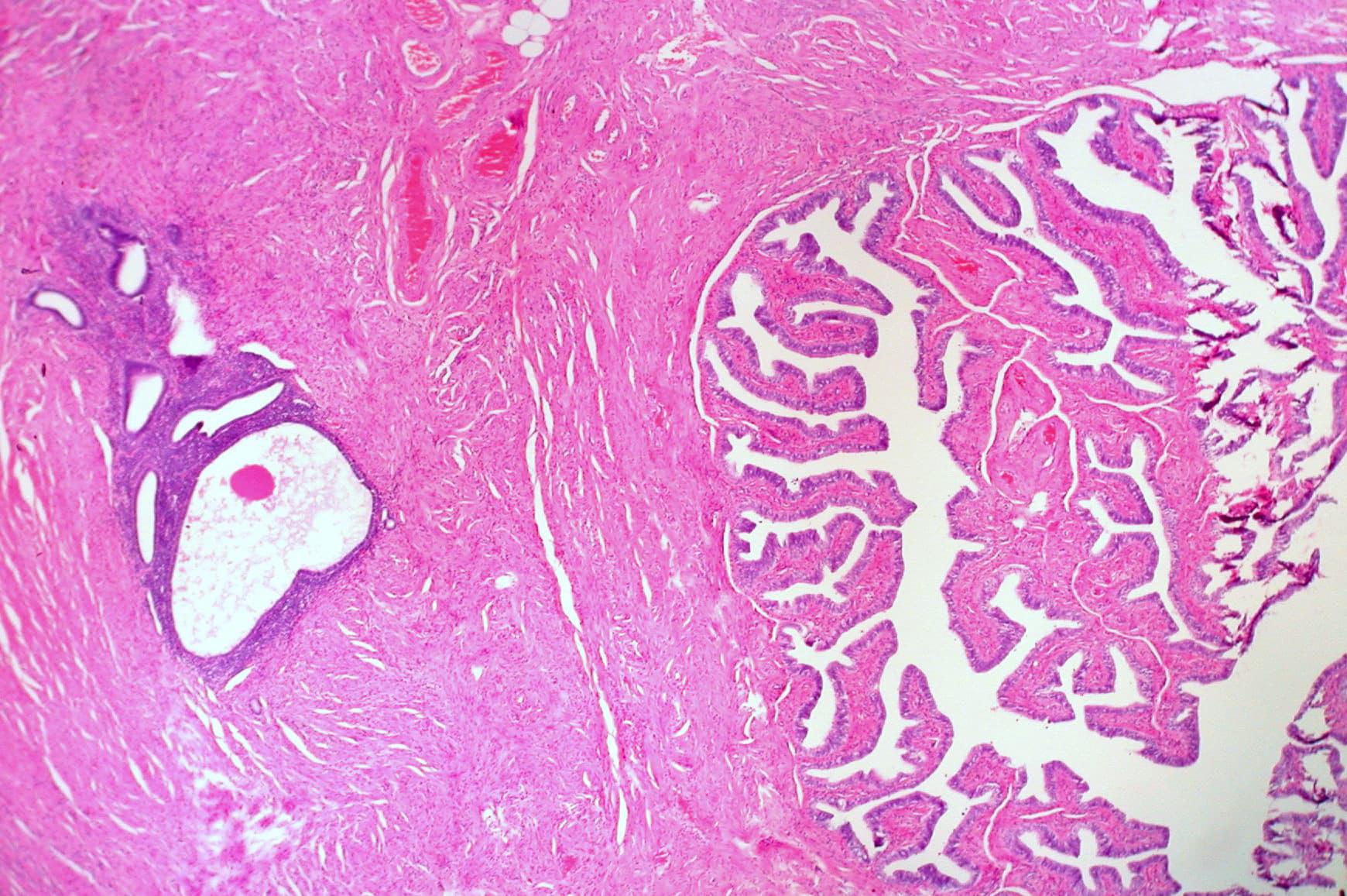 Endometriosis in Wall of Fallopian Tube | Image by Ed Uthman (Flickr)